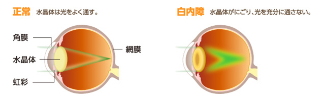 白内障とは？