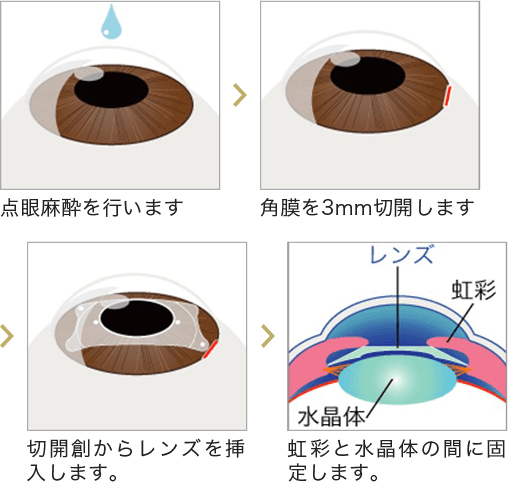 ICL手術の概要（後房）