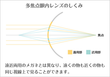 多焦点眼内レンズ(老眼・老視治療)について ※健康保険適用外