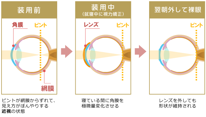 オルソケラトロジーとは