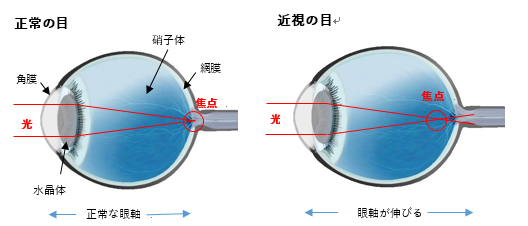 近視について