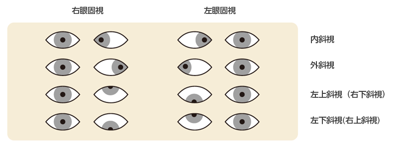 斜視について