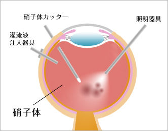 手術方法