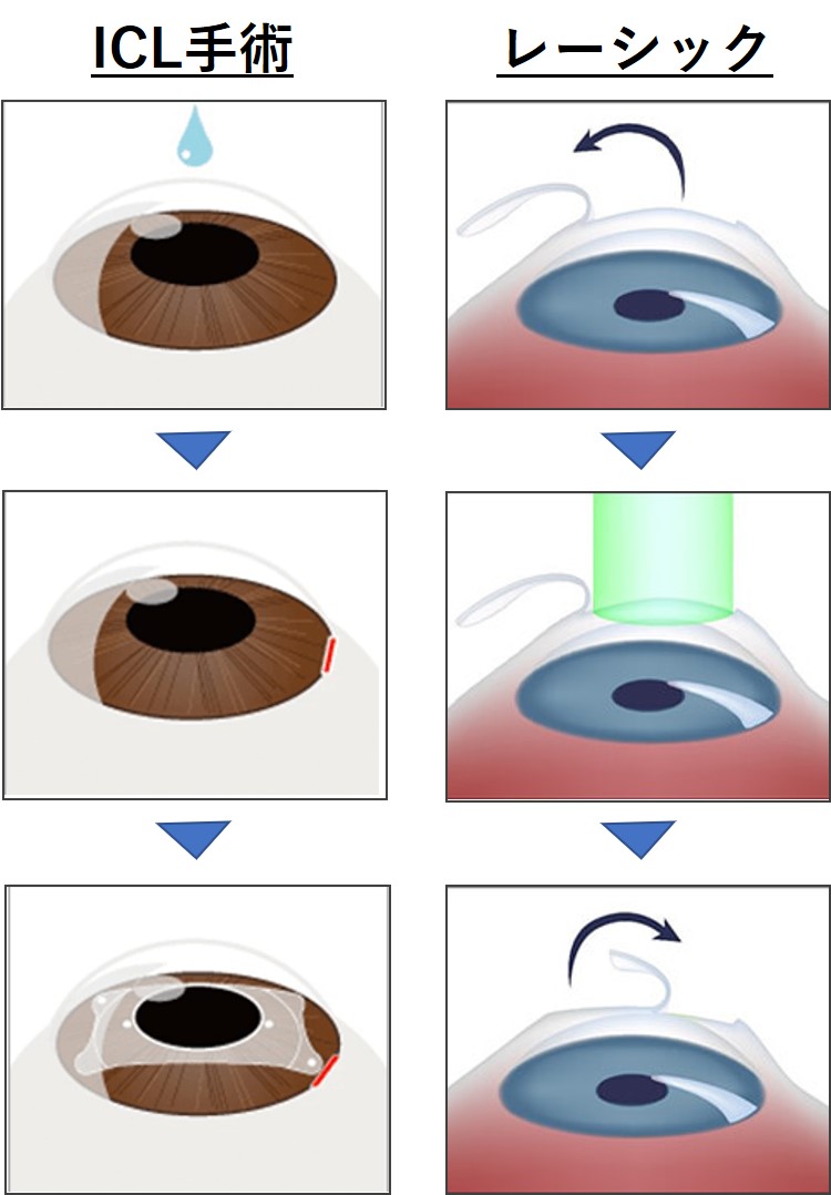 レーシック icl