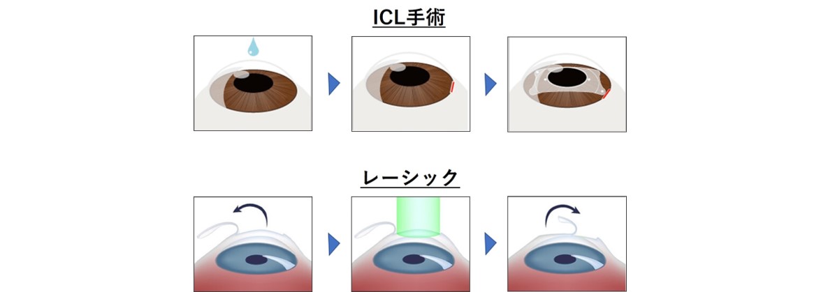 角膜を削らないので 見え方の質が高い