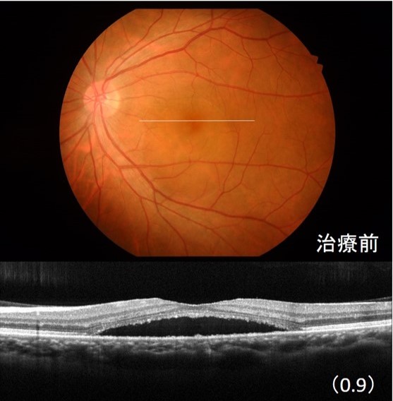 中心性漿液性脈絡網膜症治療前