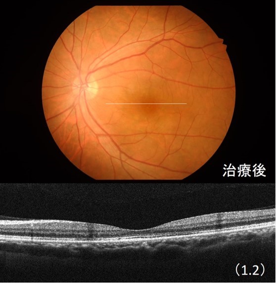 中心性漿液性脈絡網膜症治療後