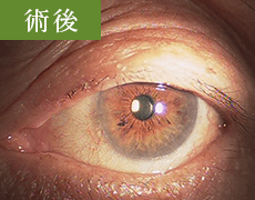 眼瞼腫瘍