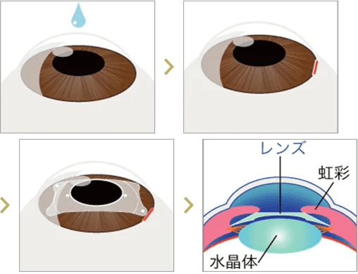 ICL手術の概要