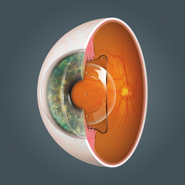 ICL(眼内コンタクトレンズ)とは