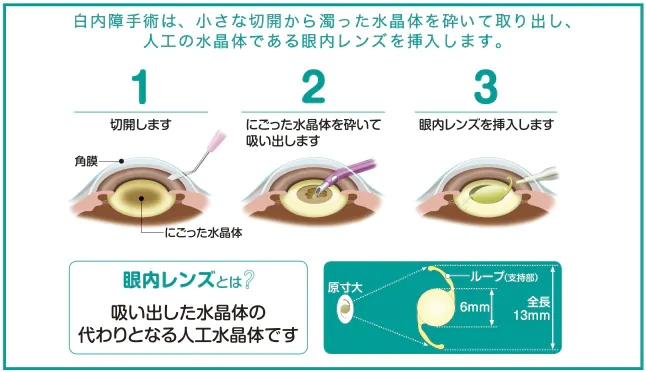 現在の白内障手術は超音波乳化吸引術といいます