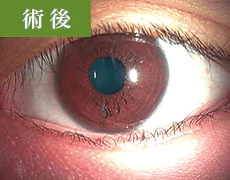 眼瞼内反症および睫毛内反症