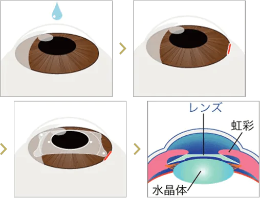 ICL手術の概要